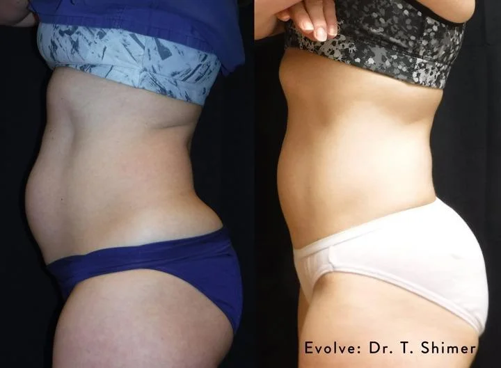 InMode Evolve Trim Before And After in Long Beach, CA
