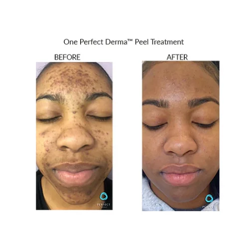 Chemical Peel Perfect Derma Before and After Treatment | Lounge of Beauty Medical Spa
