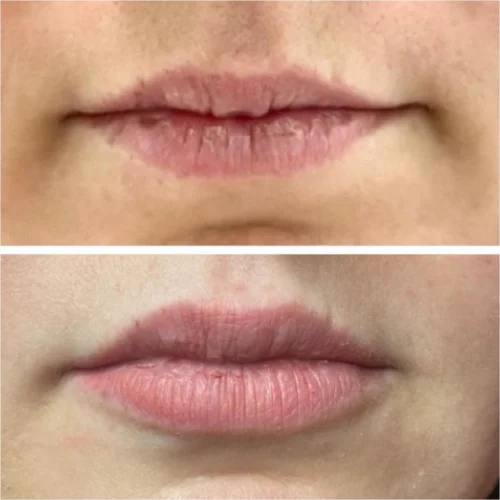 Fillers Treatment After and Before 1