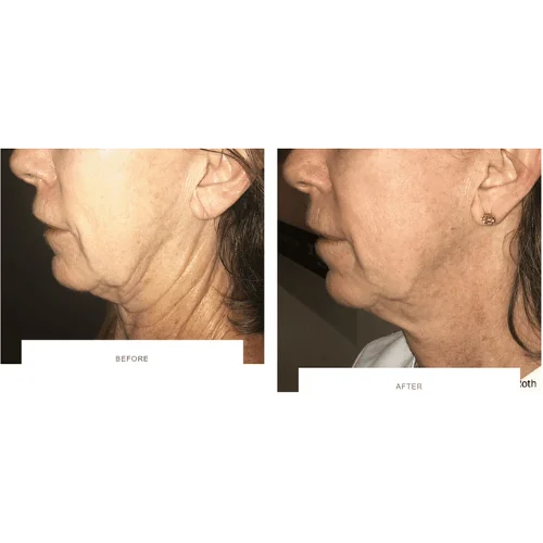 Morpheus8 RF Microneedling Before and After Treatment | Lounge of Beauty Medical Spa