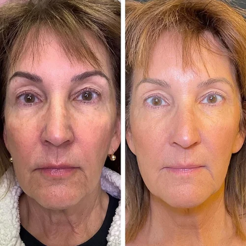 Morpheus8 RF Microneedling Before and After Treatment | Lounge of Beauty Medical Spa