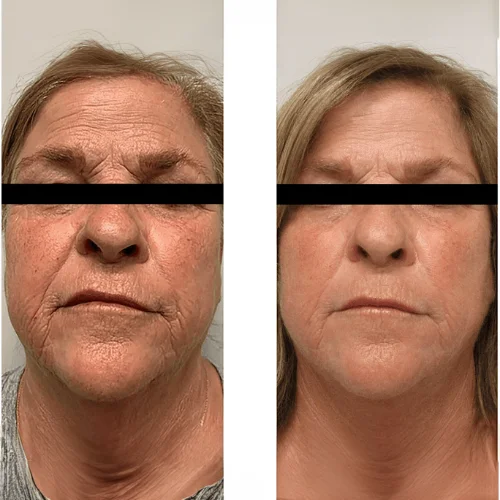Morpheus8 RF Microneedling Before and After Treatment | Lounge of Beauty Medical Spa