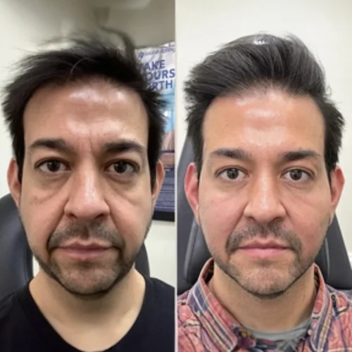 Sculptra Before and After Treatment | Lounge of Beauty Medical Spa