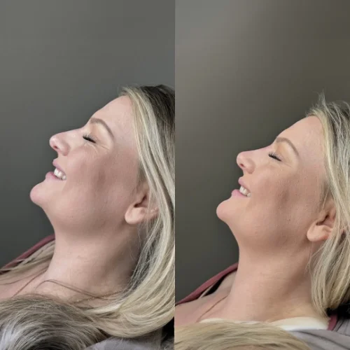 Fillers Before and After Treatment | Lounge of Beauty Medical Spa