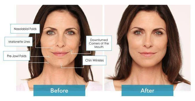 Dermal Fillers in Long Beach, CA | Lounge of Beauty Medical Spa