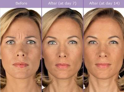 Botox Treatment Before and After | Lounge of Beauty Medical Spa