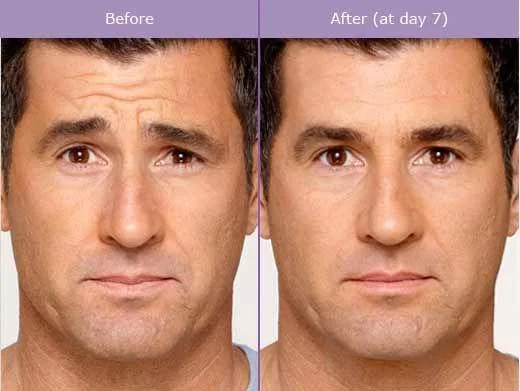 How Long Does Botox Last in Long Beach, CA