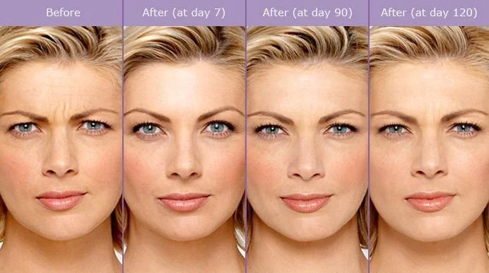 How Much Does Botox Cost in Long Beach, CA