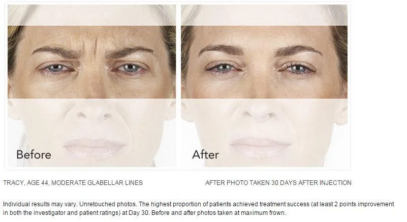 XEOMIN Injections Can Help Reduce Frown Lines in Long Beach, CA