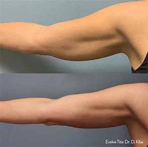 InMode Evolve Tone: Improves Muscle Tone And Build in Long Beach , CA