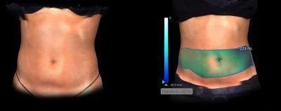 InMode Evolve Tone: Improves Muscle Tone And Build Before And After