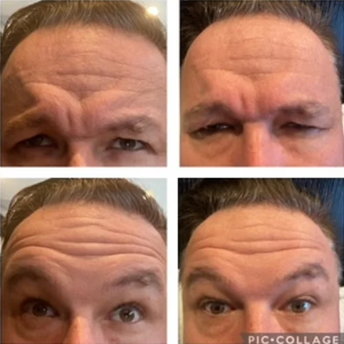 Botox Before and After Treatment | Lounge of Beauty Medical Spa
