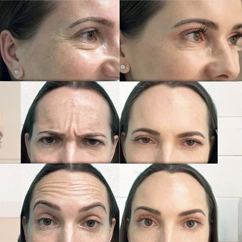 Botox Before and After Treatment | Lounge of Beauty Medical Spa