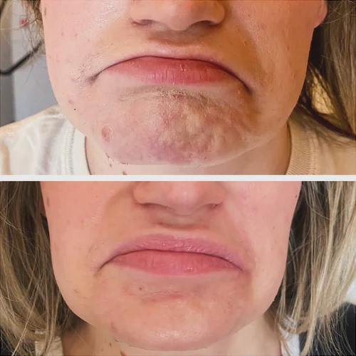 Botox Before and After Treatment | Lounge of Beauty Medical Spa