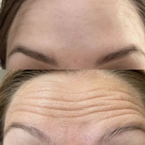 Botox Before and After Treatment | Lounge of Beauty Medical Spa