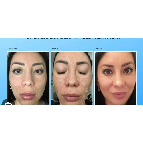 Chemical Peel Perfect Derma Before and After Treatment | Lounge of Beauty Medical Spa