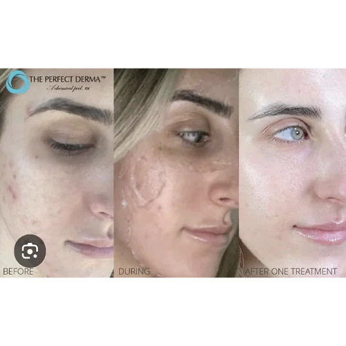 Chemical Peel Perfect Derma Before and After Treatment | Lounge of Beauty Medical Spa
