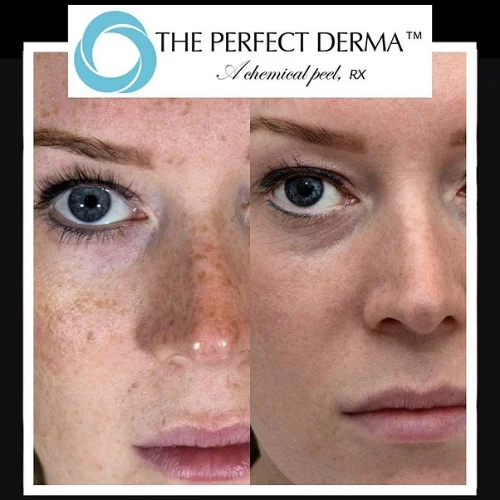 Chemical Peel Perfect Derma Before and After Treatment | Lounge of Beauty Medical Spa