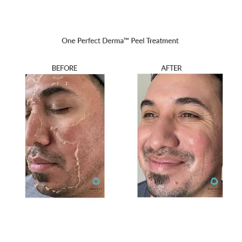Chemical Peel Perfect Derma Before and After Treatment | Lounge of Beauty Medical Spa