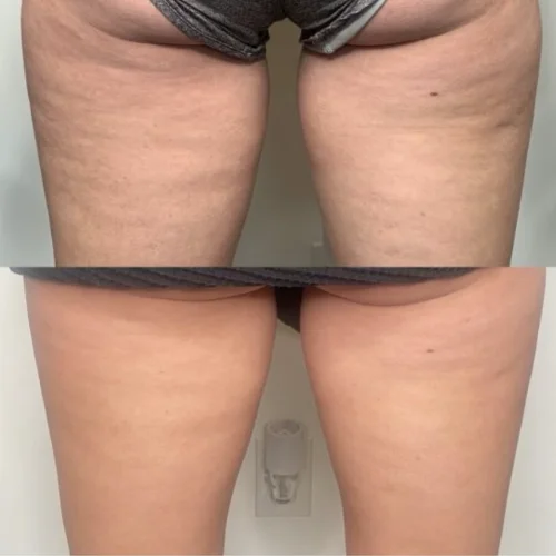 Evolve Body Contouring Before and After Treatment | Lounge of Beauty Medical Spa