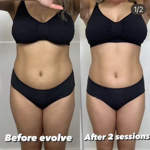 Evolve Body Contouring Before and After Treatment | Lounge of Beauty Medical Spa