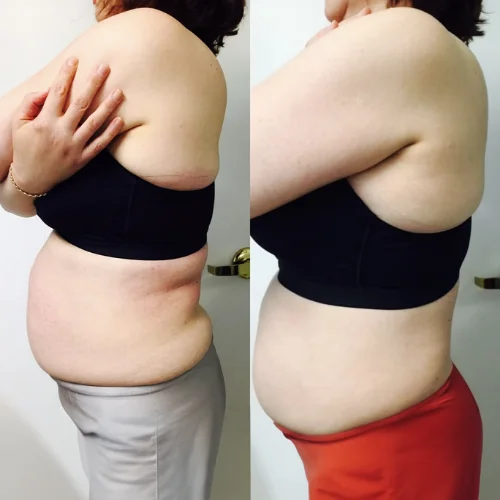 Evolve Body Contouring Before and After Treatment | Lounge of Beauty Medical Spa