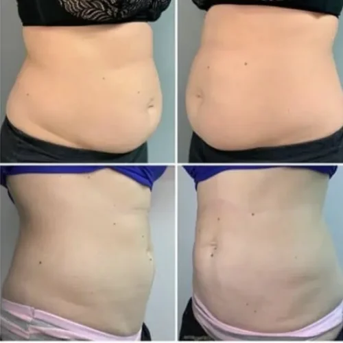 Evolve Body Contouring Before and After Treatment | Lounge of Beauty Medical Spa