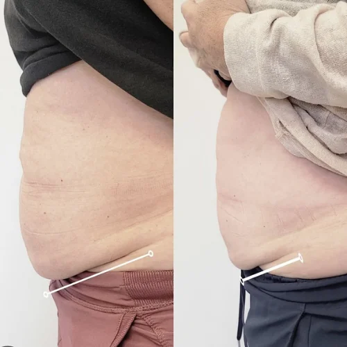 Evolve Body Contouring Before and After Treatment | Lounge of Beauty Medical Spa