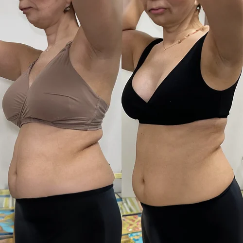 Evolve Body Contouring Before and After Treatment | Lounge of Beauty Medical Spa