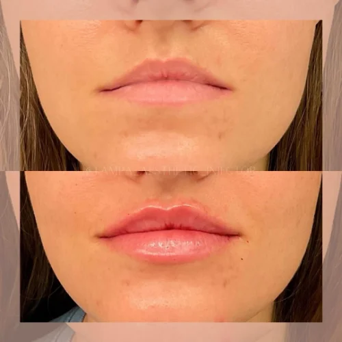 Fillers Treatment After and Before 7