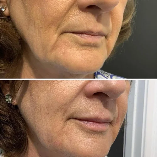 Fillers Treatment After and Before 6