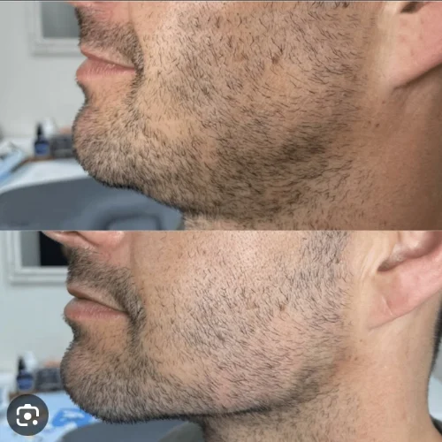 Fillers Treatment After and Before 5