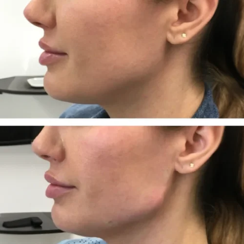 Fillers Treatment After and Before 4