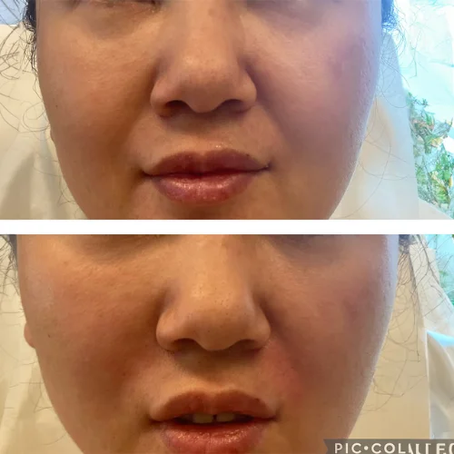 Fillers Treatment After and Before 3