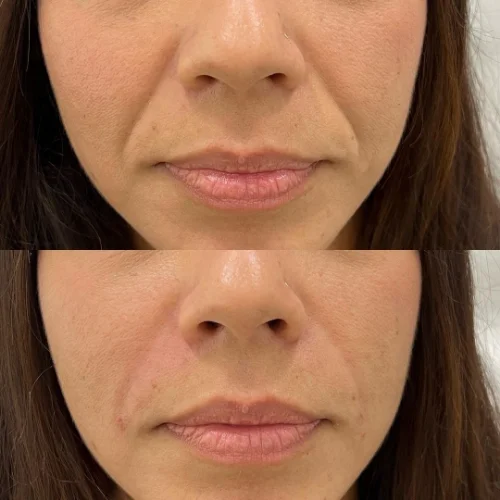 Fillers Treatment After and Before