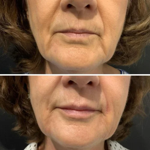 Fillers Before and After Treatment | Lounge of Beauty Medical Spa