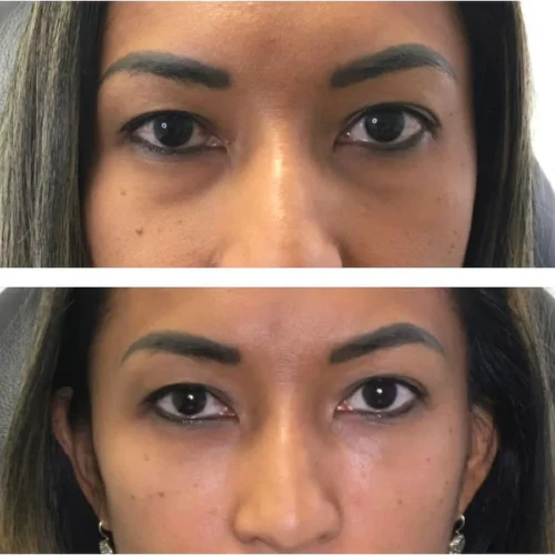 Fillers Before and After Treatment | Lounge of Beauty Medical Spa