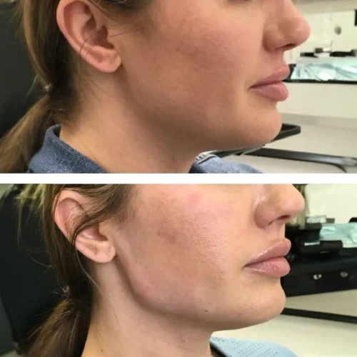 Fillers Before and After Treatment | Lounge of Beauty Medical Spa