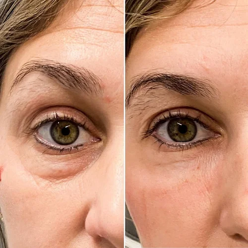 Fillers Before and After Treatment | Lounge of Beauty Medical Spa