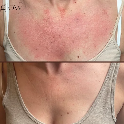 IPL Lumecca Before and After Treatment | Lounge of Beauty Medical Spa