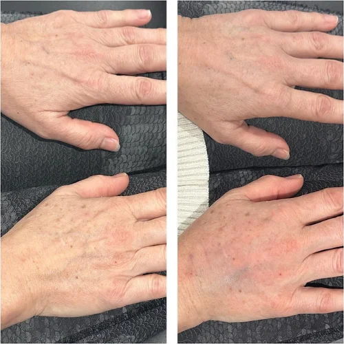 IPL Lumecca Before and After Treatment | Lounge of Beauty Medical Spa