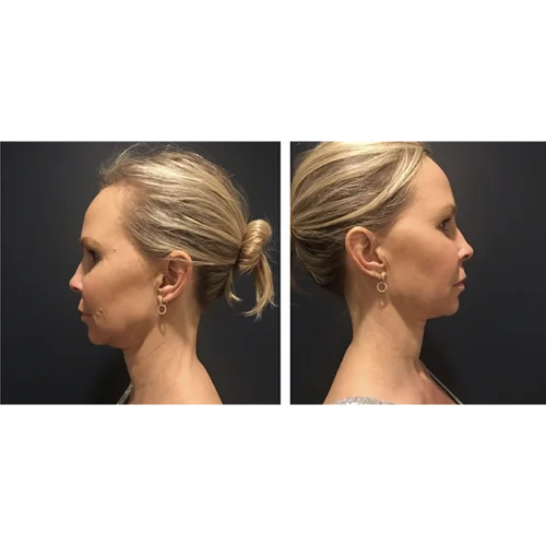 Kybella Before and After Treatment | Lounge of Beauty Medical Spa in Long Beach, CA
