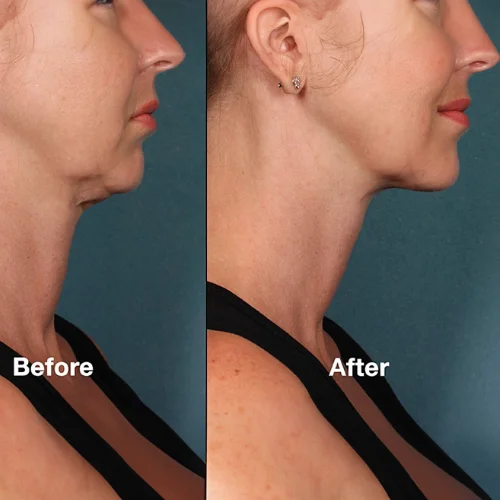 Kybella Before and After Treatment | Lounge of Beauty Medical Spa in Long Beach, CA