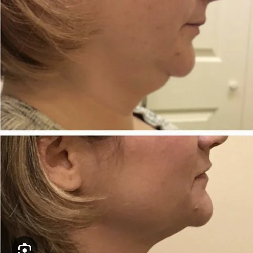 Kybella Before and After Treatment | Lounge of Beauty Medical Spa in Long Beach, CA