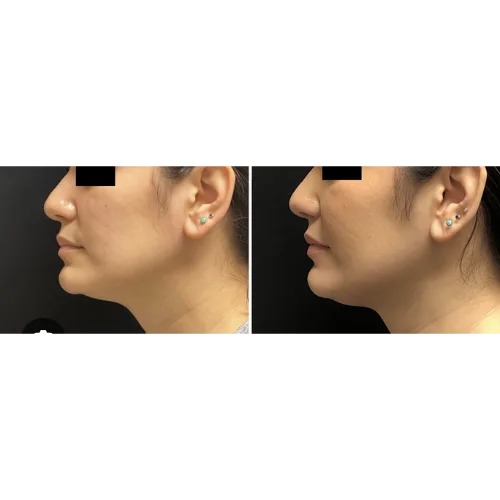 Kybella Before and After Treatment | Lounge of Beauty Medical Spa in Long Beach, CA