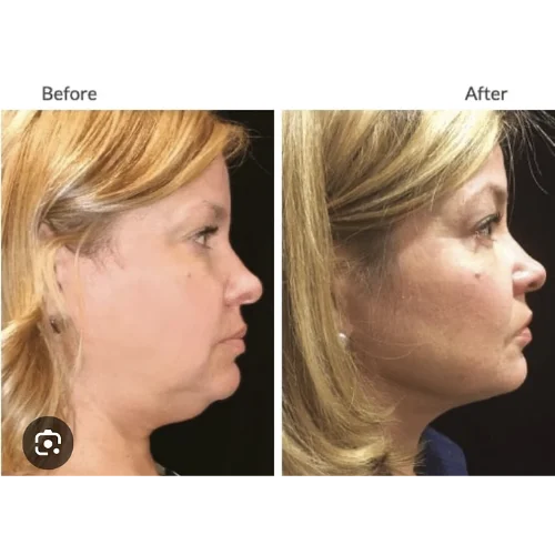 Kybella Before and After Treatment | Lounge of Beauty Medical Spa in Long Beach, CA