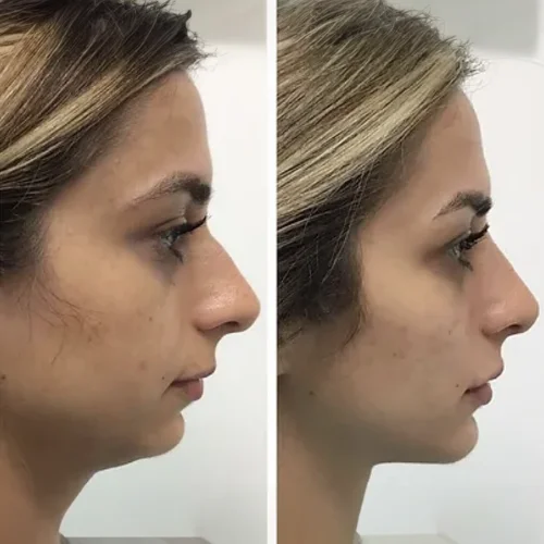 Kybella Before and After Treatment | Lounge of Beauty Medical Spa in Long Beach, CA