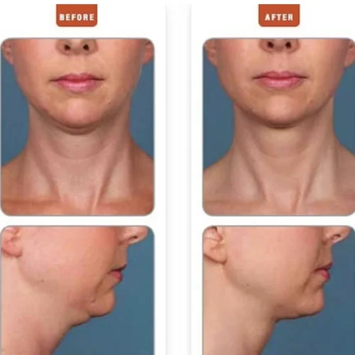 Kybella Before and After Treatment | Lounge of Beauty Medical Spa in Long Beach, CA