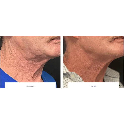 Morpheus8 RF Microneedling Before and After Treatment | Lounge of Beauty Medical Spa