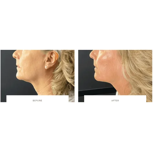 Morpheus8 RF Microneedling Before and After Treatment | Lounge of Beauty Medical Spa